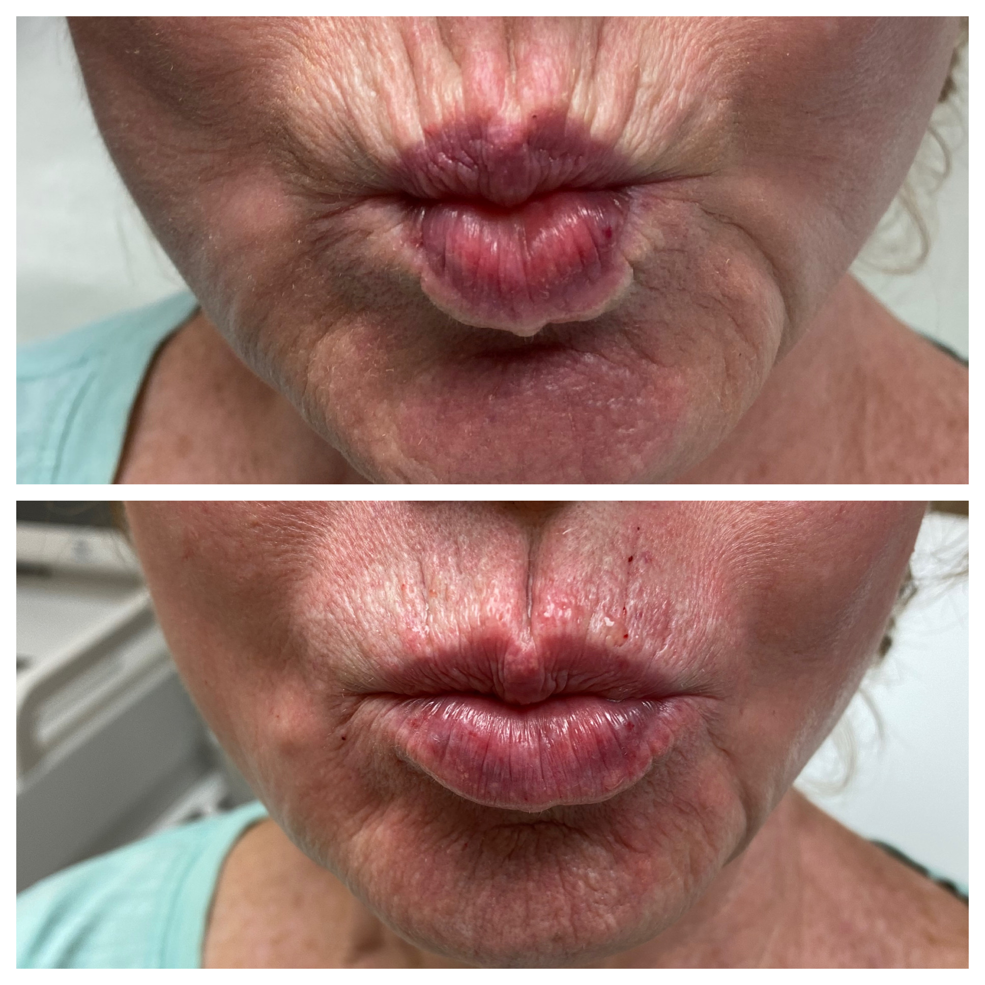 Before and immediately after RHA Redensity treatment by Cam Cumming, RN, using one 1 mL syringe along the lip border and fine lines around the mouth.
